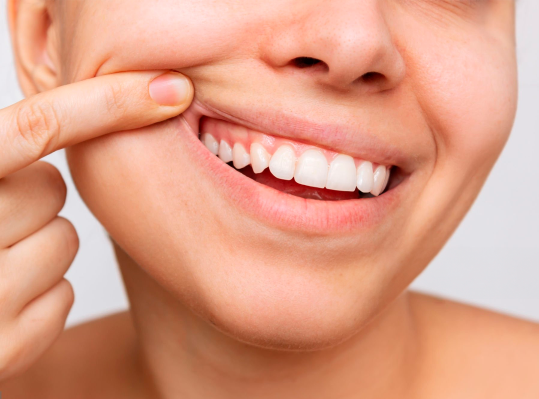 sonrisa gingival
