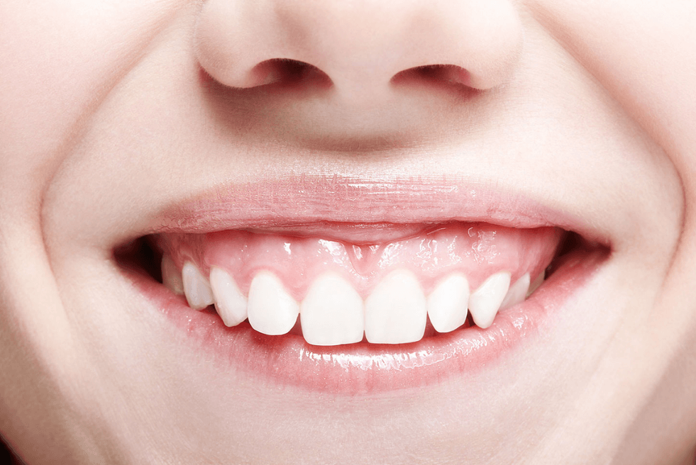 Sonrisa gingival