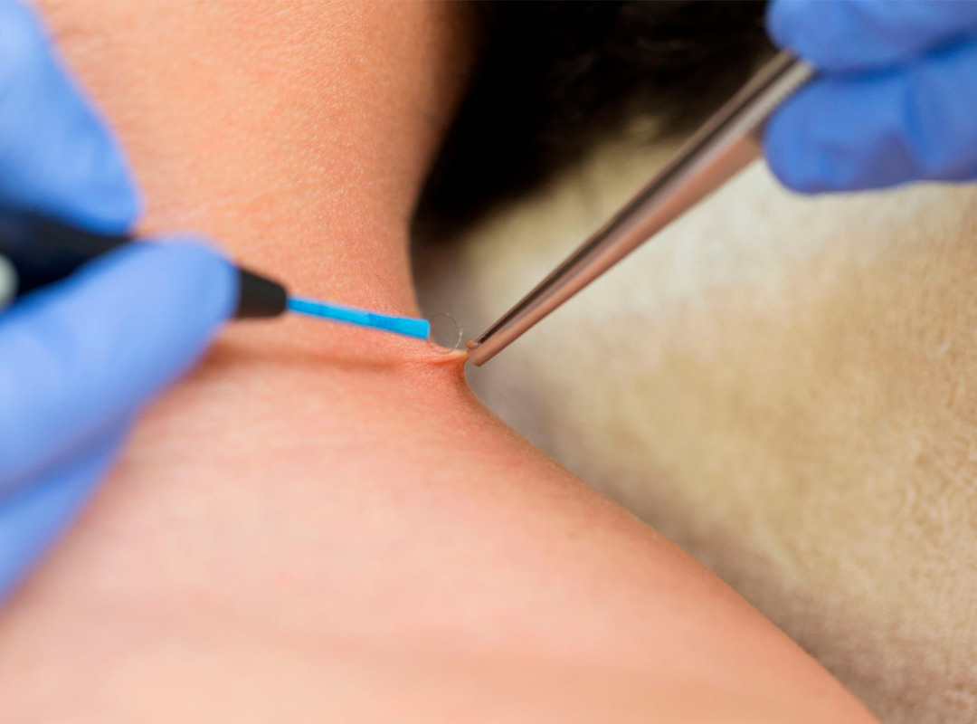 electrocauterización