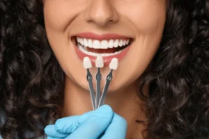 carillas dentales