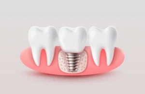 implante dental