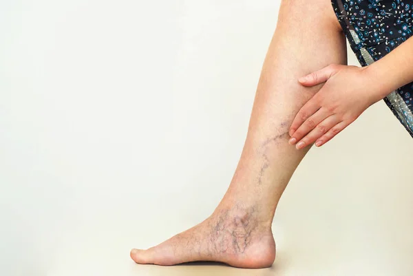 Varices