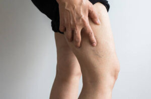 Varices