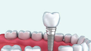 Implantes de carga inmediata