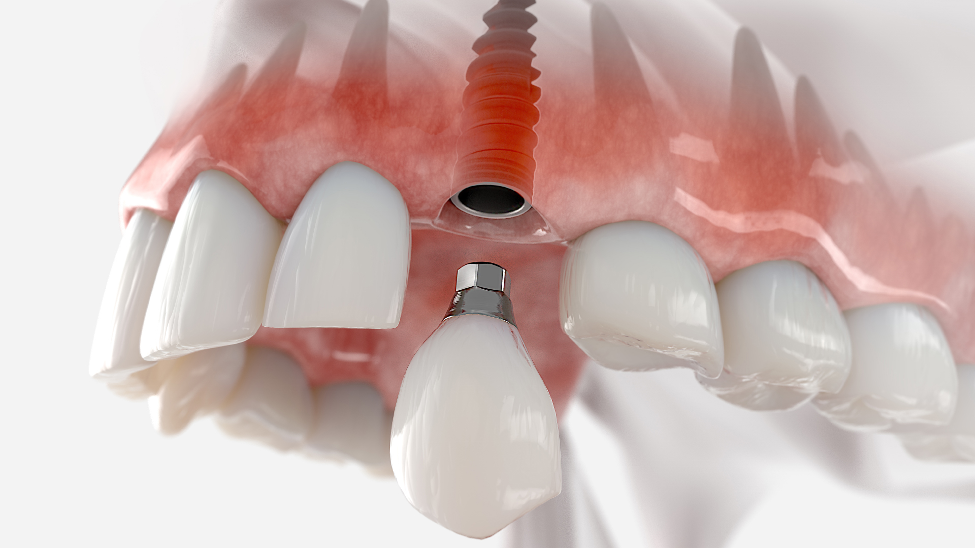 Implantes de carga inmediata