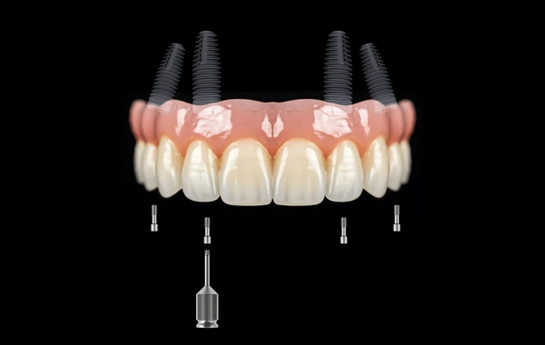 Implantes dentales All-on-4