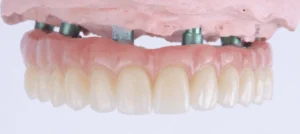 Implantes dentales All-on-6