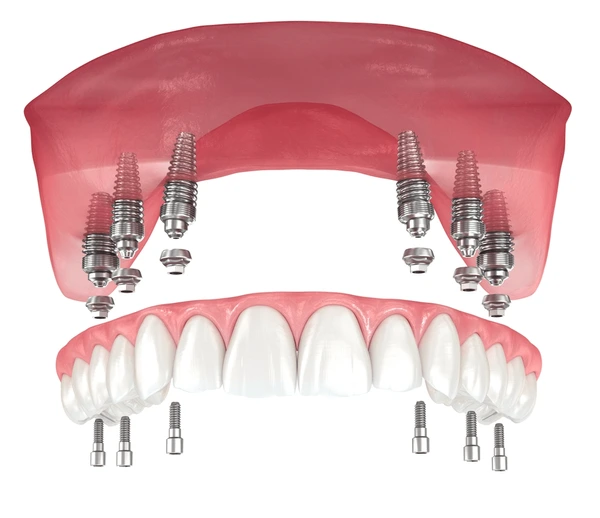 Implantes dentales All-on-6