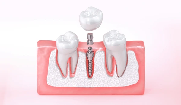 implantes dentales de titanio