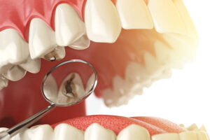 Caries dentales