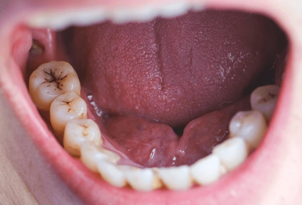 Caries dentales
