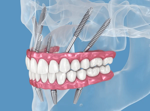 Implantes dentales cigomáticos