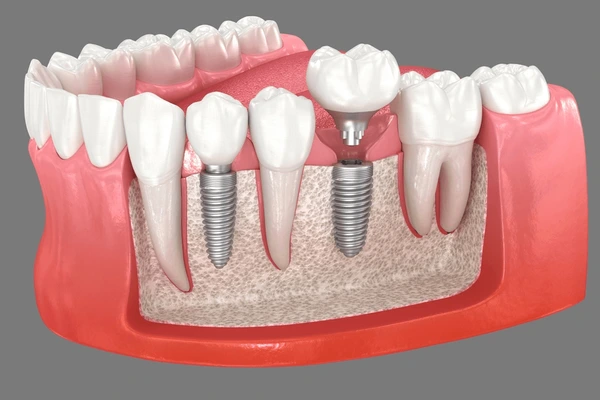 Implantes dentales con tornillos
