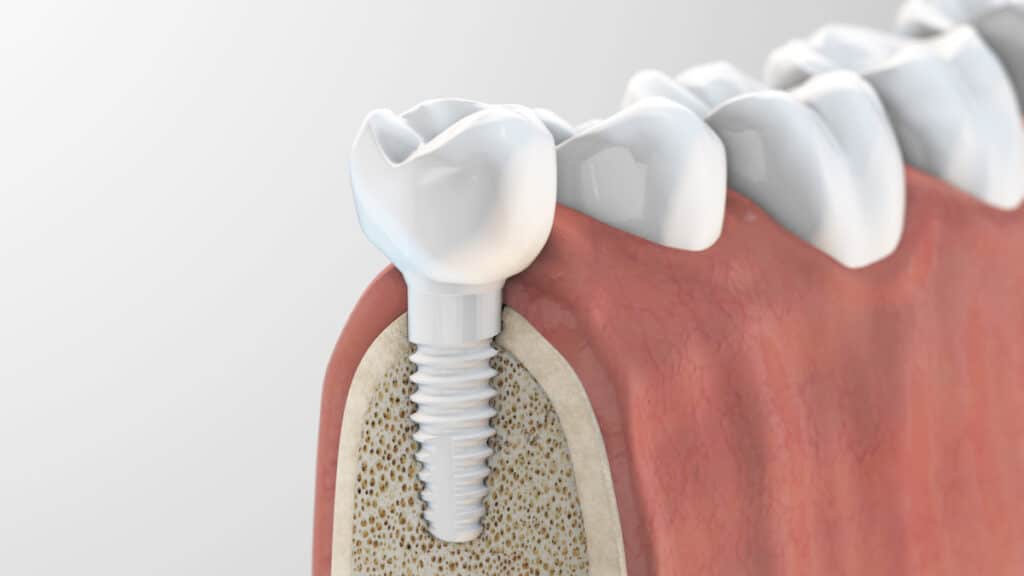 Implantes dentales de cerámica