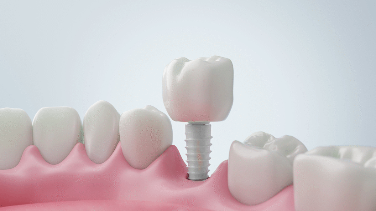 Implantes dentales de zirconio
