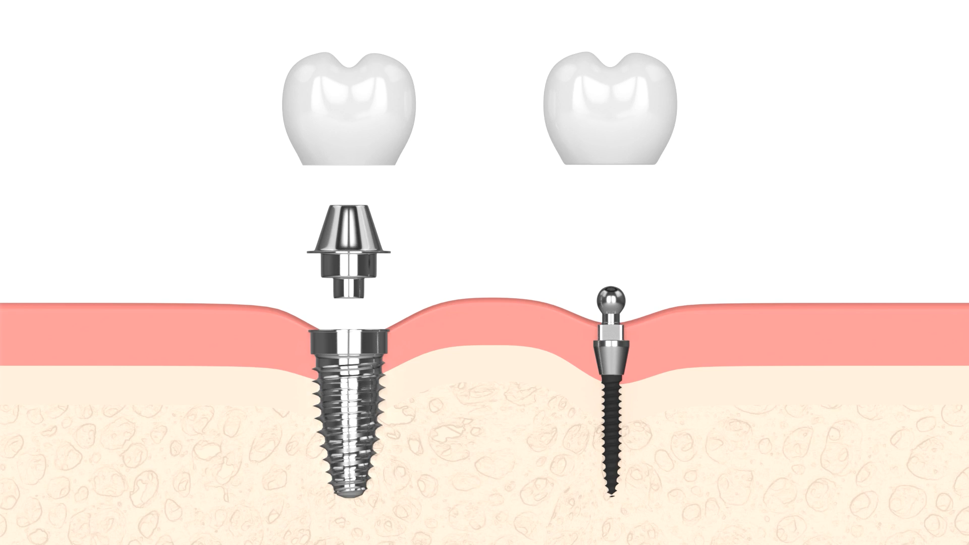 Implantes dentales sin tornillos