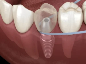 dolor de implantes dentales