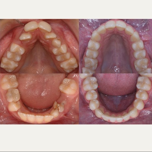 INVISIBLES 5 Disyunción del Maxilar y Alineación Dentaria